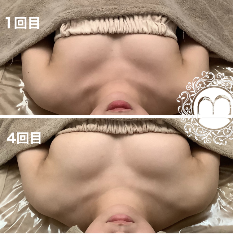 美乳再生の施術結果、1回目と4回目の比較